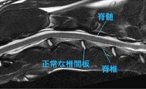 【MR画像、頚部矢状断像、正常例】