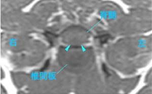 【MR画像、病変部の横断像、T1強調画像】