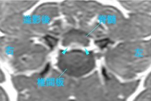 【MR画像、病変部の横断像、造影後T1強調画像】