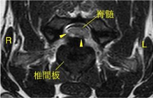 【MR画像、横断像、T2強調画像】
一般的な椎間板ヘルニア（I型）
