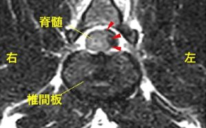 【MR画像、横断像（L2-3）、T2強調画像】