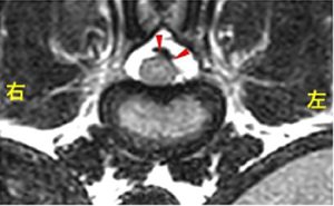 【MR画像、横断像（T12-13）、T2強調画像】