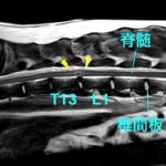 【MR画像、胸腰部矢状断像、T2強調画像】