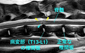 【MR画像、胸腰部矢状断像、T2強調画像】