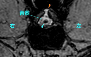 【MR画像、横断像T13-L1、T2*強調画像】