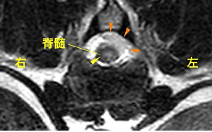 6 椎間板ヘルニア(急性非圧迫性髄核逸脱：ANNPE)【画像診断 
