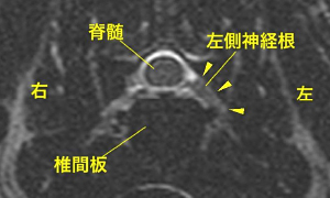 【MR画像、C5-6横断像、T2強調画像】