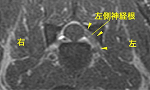 【MR画像、C5-6横断像、造影T1強調画像】