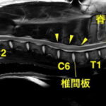 【MRI、頚部矢状断像、T2強調画像】