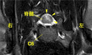 【MRI、C6病変部横断像、T2強調画像】