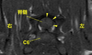 【MRI、C6病変部横断像、T1強調画像】