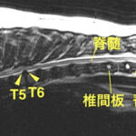 【MRI、胸部矢状断像、T2強調画像】