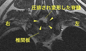 【MRI、C5-6横断像、T2強調画像】