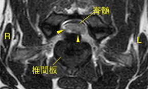#63 頚部椎間板ヘルニア（I型）[神経疾患(脊髄)]