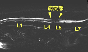 【MRI、腰部矢状断像、MRミエログラフィー】