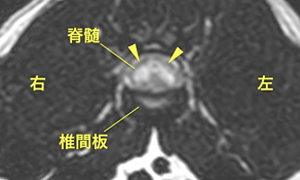 【MRI、L4-5横断像、T2強調画像】