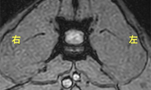 【MRI、L4-5横断像、T2*強調画像】