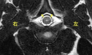 【MRI、病変部横断像(T3-4)、T2強調画像】