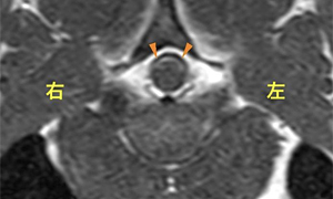【MRI、病変部横断像(T3-4)、造影T1強調画像】