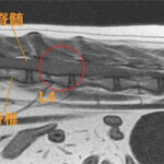 【MRI、腰部矢状断像、T1強調画像】