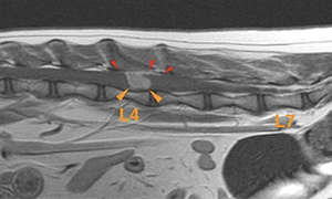 【MRI、腰部矢状断像、造影後T1強調画像】