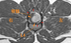 【MR画像、病変部の横断像、造影後T1強調画像】