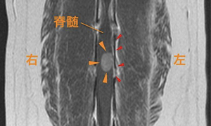 【MR画像、背断像、造影後T1強調画像】