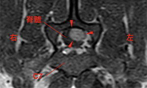 【MRI、横断像(C7)、造影T1強調画像】