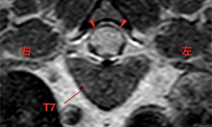 【MRI、横断像（T7）、造影T1強調画像】