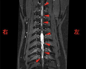 【MRI、胸部背断像、脂肪抑制造影T1強調画像】