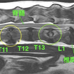 【MRI、胸腰部矢状断像、T2強調画像】