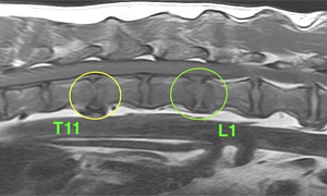 【MRI、胸腰部矢状断像、T1強調画像】