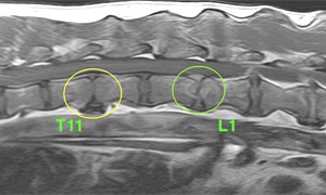 【MRI、胸腰部矢状断像、造影T1強調画像】