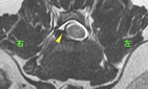 【MRI、L1-2横断像、T2強調画像】