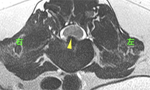 【MRI、L4-5横断像、T2強調画像】