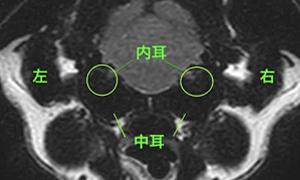 【MRI、中耳/内耳レベル横断像、FLAIR画像】<br>正常例
