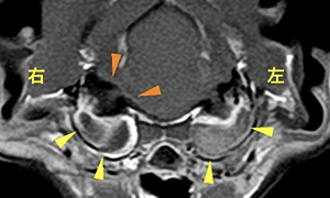 【MRI、中耳/内耳レベル横断像、造影T1強調画像】<br>本症例
