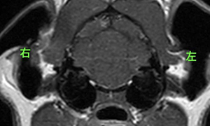 【MRI、中耳/内耳レベル横断像、造影T1強調画像】<br>正常例