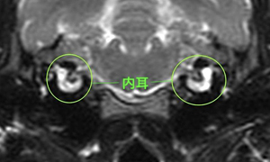 【MRI、中耳/内耳レベル横断像、T2強調画像】<br>正常例