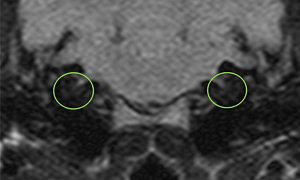 【MRI、中耳/内耳レベル横断像、FLAIR画像】<br>正常例