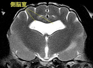 【MRI、側脳室レベル横断像、T2強調画像】