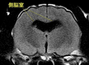 【MRI、側脳室レベル横断像、FLAIR画像】