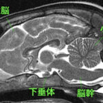 【MRI、矢状断像、T2強調画像】