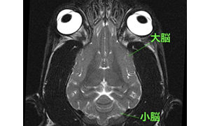 【MRI、背断像、T2強調画像】