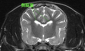 【MRI、横断像、T2強調画像】<br>本症例