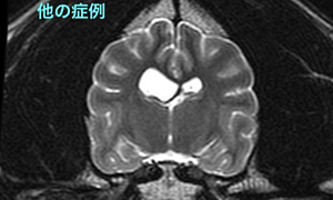 【MR画像、横断像、T2強調画像】<br>他の症例