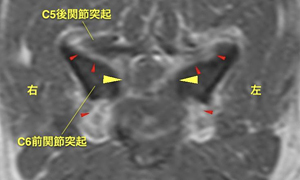 【MRI、C5-6横断像、造影T1強調画像】