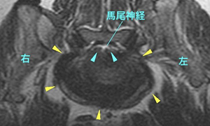 【MRI、L7-S1横断像、T2強調画像】