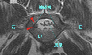 【MRI、L7-S1頭側横断像、T2強調画像】