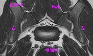 【MRI、L7-S1横断像、T2強調画像（正常例）】